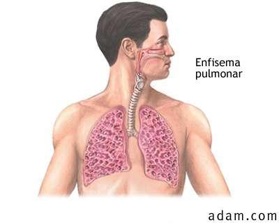 Pacientes que sofrem uma anestesia geral, que tem alguma doença pulmonar crônica ou que ficam muito tempo acamados podem, eventualmente, apresentar uma atelectasia; Num adulto, a atelectasia