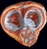 No ciclo cardíaco normal os dois átrios se contraem, enquanto os dois ventrículos