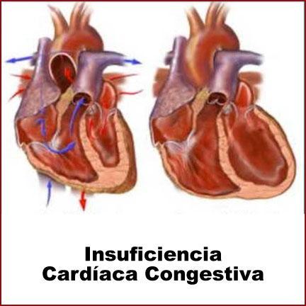 Doenças que podem alterar a contractilidade do coração. A causa mais frequente é a doença ateroesclerótica do coração. Doenças que exigem um esforço maior do músculo cardíaco.