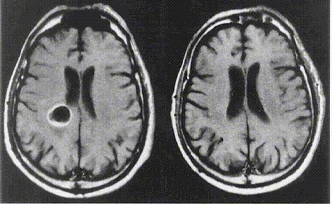 Glioblastoma Multiforme (Coma +) Tumor