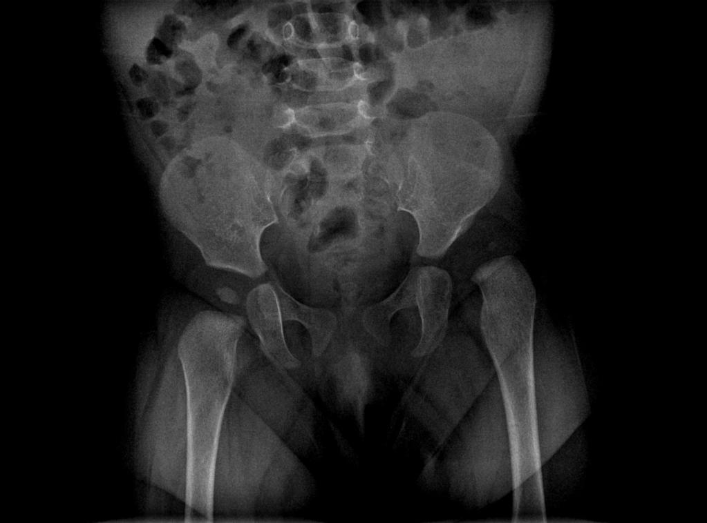 Os sinais clássicos de limitação da abdução da anca e encurtamento do membro (sinal de Galeazzi) aumentam ao longo das primeiras semanas e meses de vida (Figura 18).