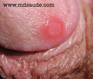 Sífilis Causador: Treponema pallidum; Sintomas: feridas indolores com as bordas