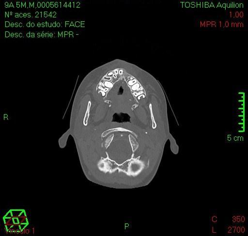 31 FIGURA 7 - Tomografias do mesmo paciente no pré-operatório (a esquerda) e pós-operatório de seis meses (a direita) do Grupo BMP.