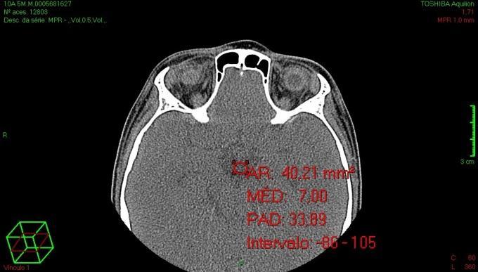 34 FIGURA 10 - Tomografia de paciente do estudo. Indicado pela seta azul, marcação oval vermelha dentro do IV ventrículo no algoritmo de partes moles cuja densidade é indicada pela sigla MÉD: 7,00.
