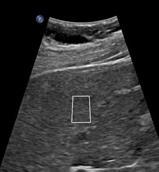 TÉCNICA DO EXAME REGIÃO DE INTERESSE # FIBROSCAN: