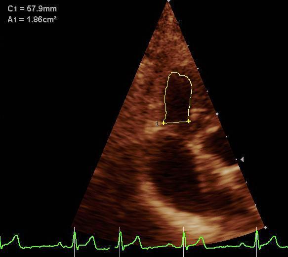Representação das medidas do diâmetro interno do VD, pela ecocardiografia bidimensinal.