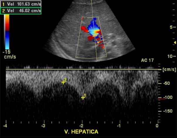 hepática. Traçado espectral do fluxo de padrão monofásico Figura 7. Veia hepática do fígado transplantado.