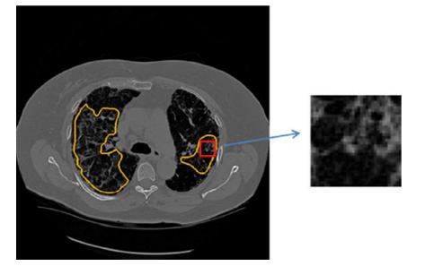 Extração de blocos de tecido pulmonar Blocos x,y não sobrepostos de 32x32 pixels; Pelo
