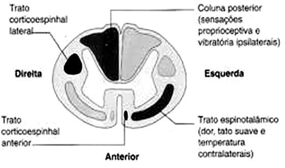 membros inferiores, hipertonia, hiperreflexia miotática com aumento de área reflexógena e sinal de Babinski bilateral, nível sensitivo tátil - doloroso em T4.