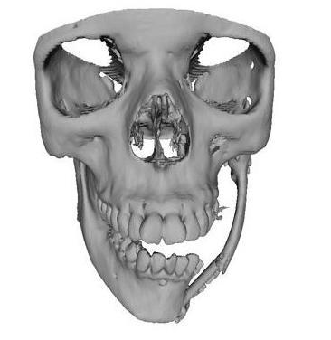parassínfise esquerda, onde, na imagem tomográfica, apresentava uma área hipodensa sugestiva de osteólise. FIGURA 3: Prototipagem. A: mandíbula. B: crânio.