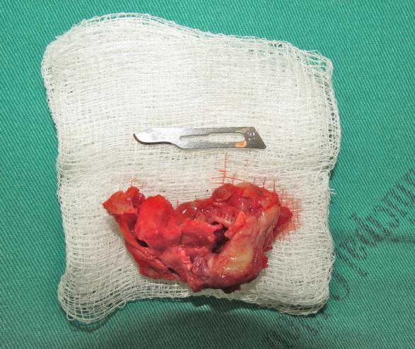 B Foi feita uma incisão intra-oral sobre o rebordo alveolar, circundando a lesão, para melhorar o acesso e facilitar a remoção