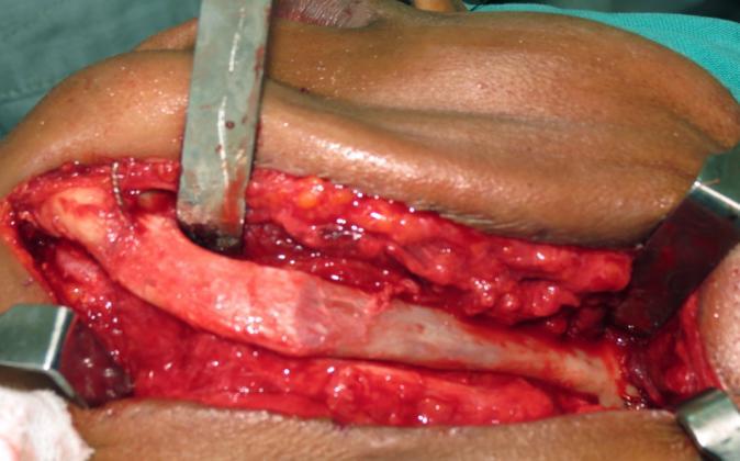 O fragmento da lesão foi removido do leito cirúrgico e enviado ao laboratório de patologia da Faculdade de Odontologia da UFMG