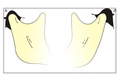 29 FIGURA 9 Assimetria bilateral do posicionamento dos côndilos na mordida cruzada posterior unilateral Fonte: Rev. Clín. Ortodon. Dental Press, Maringá, v. 5, n. 6, p. 76, dez. 2006/jan.