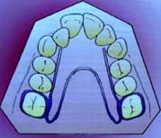 Aparelhos Fixos Tashima et al (2003), explica que os aparelhos fixos são fixados com bandas ortodônticas cimentadas nos primeiros molares permanentes superiores e no primeiro prémolar ou primeiro