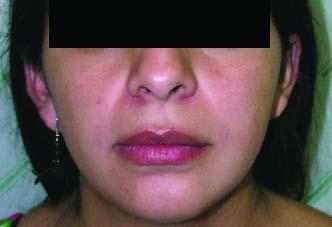O caso descrito de odontoma complexo nesta paciente do sexo feminino pode ser considerado raro já que apresenta dimensões extensas (6 cm de diâmetro).