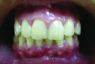 Segundo Hisatomi et al (10), Katz (11) e Budnick (12), o odontoma complexo tem predileção pelo sítio posterior da mandíbula, podendo ou não estar associado a um dente retido ou ausente na região.