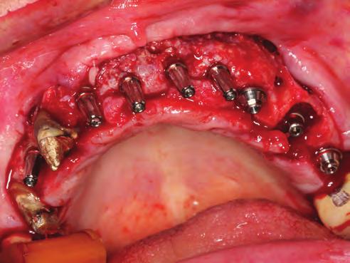 No mesmo momento cirúrgico, um implante Drive CM 3.5/11,5mm (Neodent, Curitiba, Brasil) foi instalado na região do dente 14.