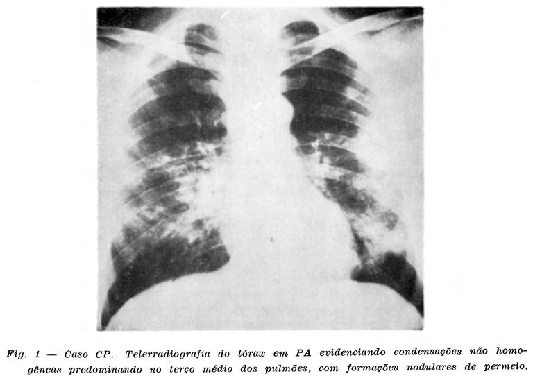 cado com antibióticos e corticóides; em outubro/81, as dores na região cervical se espraiavam pelos ombros, bilateralmente, e a queimação cedia lugar a crises álgidas, no MIE; há um ano, associada a