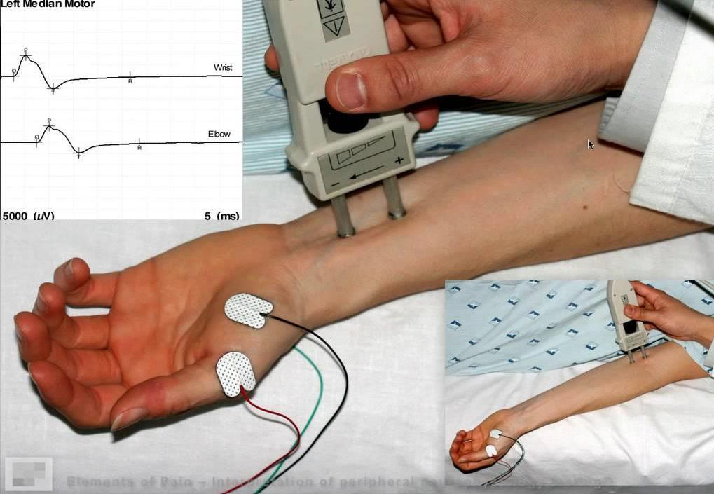 Compressão nervosa - Síndrome do túnel cárpico EMG Não essencial ao diagnóstico