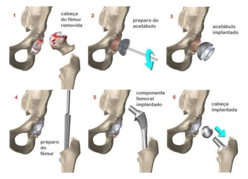 31 Figura 11 Representação do procedimento cirúrgico para colocação da prótese de quadril Fonte: CORRÊA (2014) Para averiguar se os componentes foram bem encaixados é realizada uma radiografia e