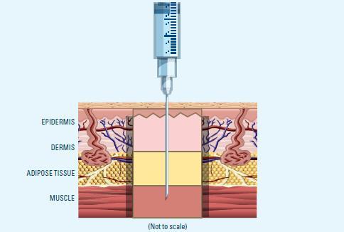 INJEÇÃO INTRAMUSCULAR - IM Definição: É a deposição de medicamento dentro do tecido muscular.