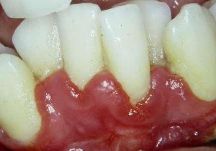 odontogênica - Profilaxia em pacientes com risco de desenvolver