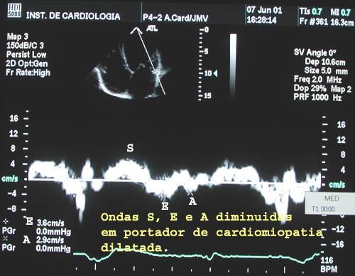 Cardiomiopatia Dilatada PAE=1,24 (E/Ea) + 1,9 R=0,87