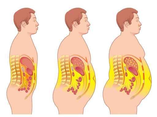 SÍNDROME METABÓLICA Como prevenir as complicações da síndrome metabólica: Tratamento da