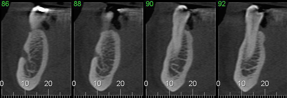 30 4.2 MÉTODOS Figura 4.1 Imagem definida como canal incisivo da mandíbula Os exames foram gerados pelos mesmos equipamentos para todos os pacientes.