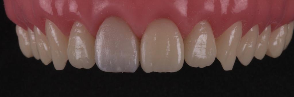 FIG 8: Resina de esmalte aplicada por sobre a dentina artificial, construindo