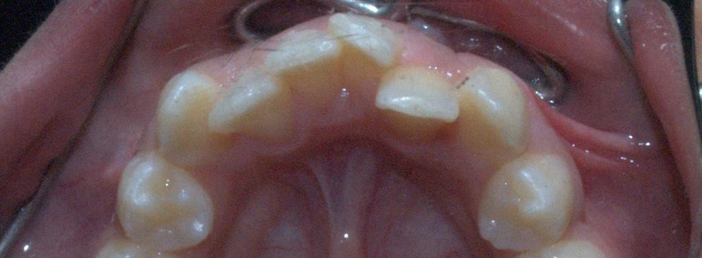 primeiros molares