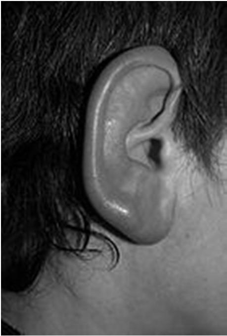 Orelha externa Pavilhão auricular: inspecionar tamanho, forma, simetria, cor (semelhante a face), implantação e condições de