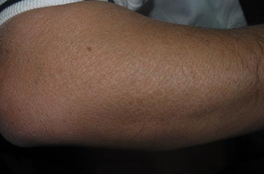 Dermatite atópica - Dermatose inflamatória crónica, recidivante
