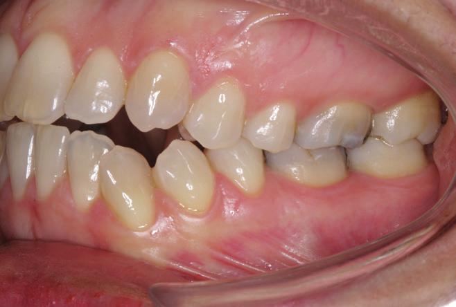 Sendo assim, proservação de 5 anos pós-tratamento. 2 3 a extrusão dos dentes anteriores superiores pode comprometer a estética interferindo na saúde das Figura 1: Fotos extra e intrabucais iniciais.