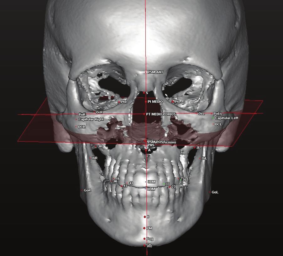 (C) Telerradiografia lateral