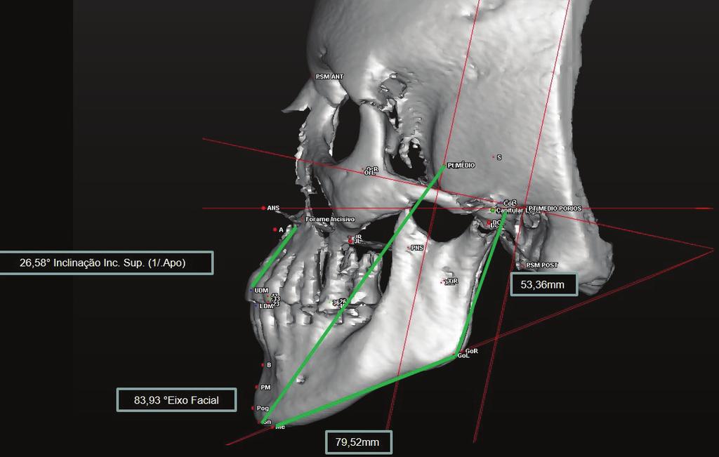 craniométrica mandibular.