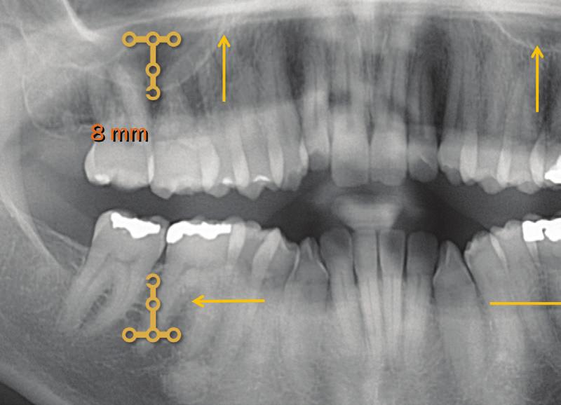 8 No tratamento proposto foram utilizadas Realizou-se a colagem dos caninos e inci- quatro