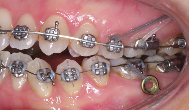 Os fios inseridos nas arcadas distalizar um pouco mais os dentes posteriores, superior e inferior