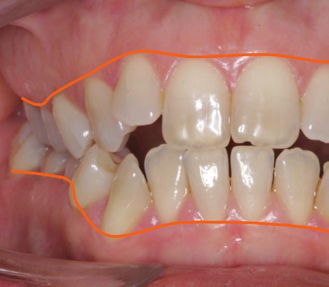 taneamente a uma distalização e expansão dos Dessa forma, seria possível posicionar os den- dentes