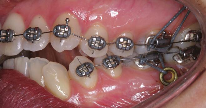 continuar a intruir os dentes posteriores supe- Iniciou-se o tratamento ortodôntico mon- riores com