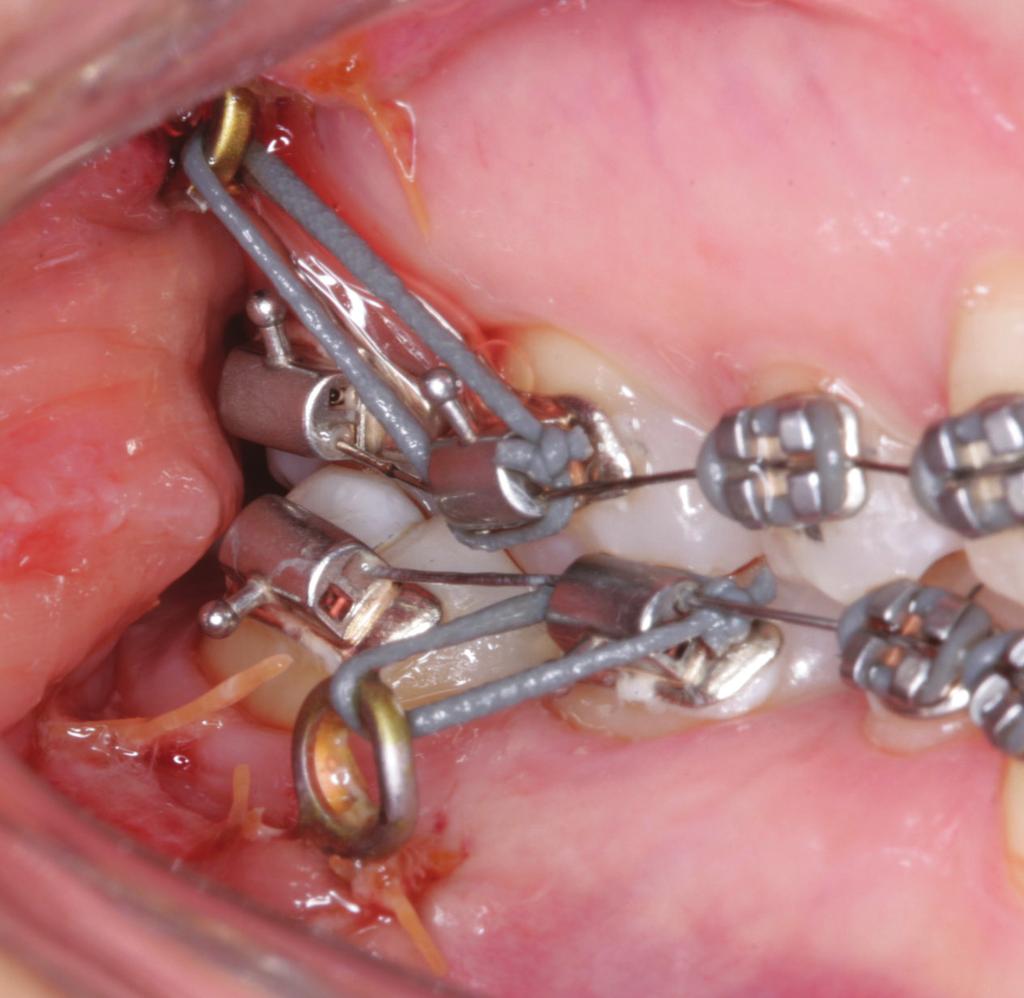 apresentavam uma inclinação palatina no slot de 0,018 x 0,030 ) superior de 7 à 7 e infe- início do