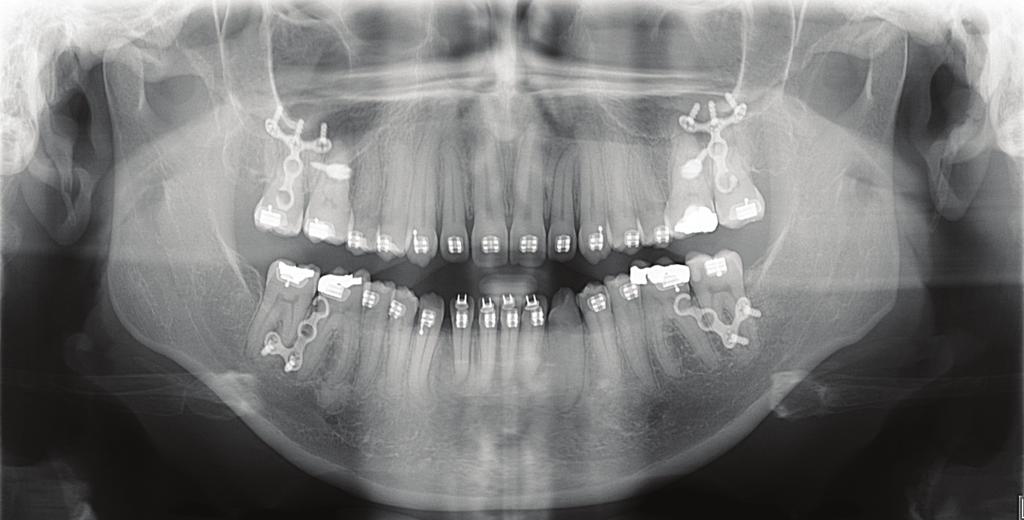 (E) Sobreposição parcial mandibular - Vista Lateral.