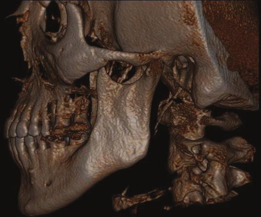 condilar, dentário e ósseo após o trata- auxiliar no fechamento da mordida aberta.