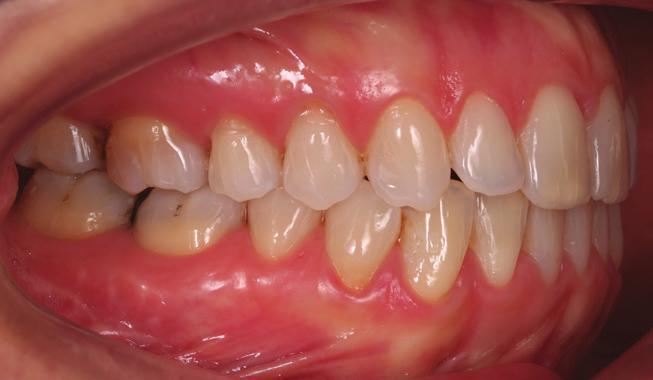 baixo dos molares maxilares ocorre durante molares superiores em um período de contenção vendo um