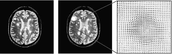 Aplicação em imagens de esclerose múltipla (II) Estimar e análisar um campo de deformação que contém