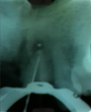 (Radiografia periapical,