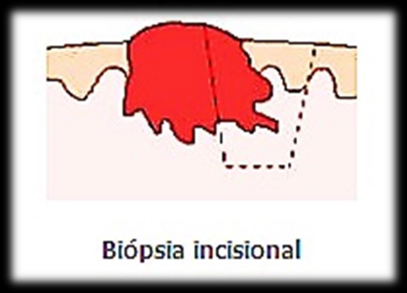 Tipos de Biópsia Incisional o Retirada a
