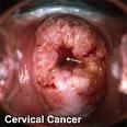 HPV e CA de colo de útero Tumor caracterizado pelo crescimento anormal das células do colo uterino Infecção por HPV de alto risco A infecção pelo HPV é uma causa necessária Outras causas associadas