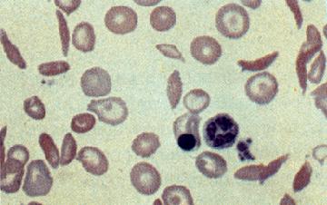 Na anemia falciforme houve uma mutação de ponto que causou a substituição do ácido glutâmico (polar positive) por valina (apolar).