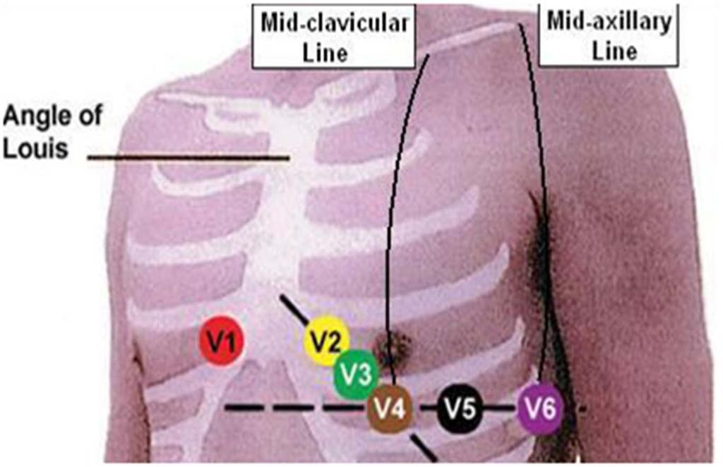 6 precordiais (tórax) Derivações unipolares precordiais (V 1 a V 6 ): obtidas com o eletrodo